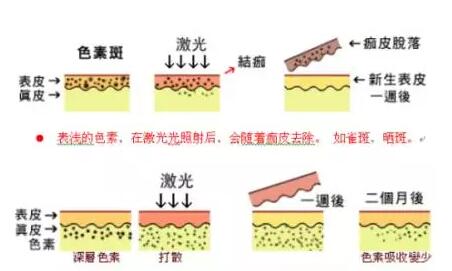 激光祛斑